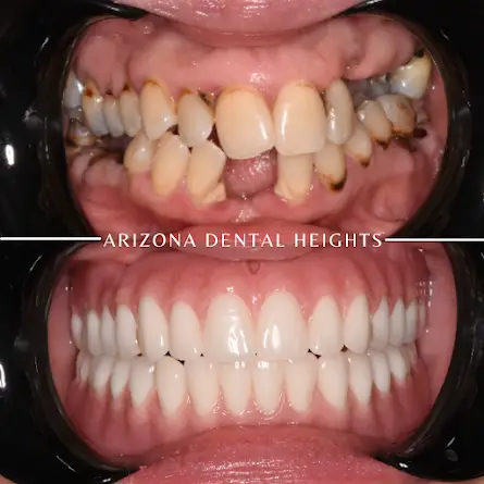 Mesa Dental Implants