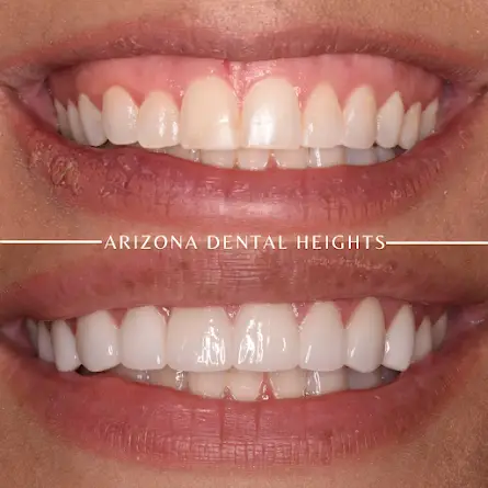 Dental Implants near Mesa