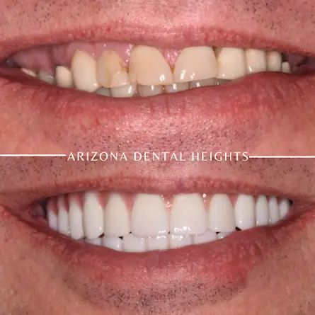 Dental Implants in Chandler