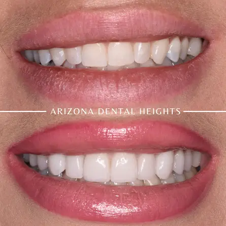 Mesa Dental Implants