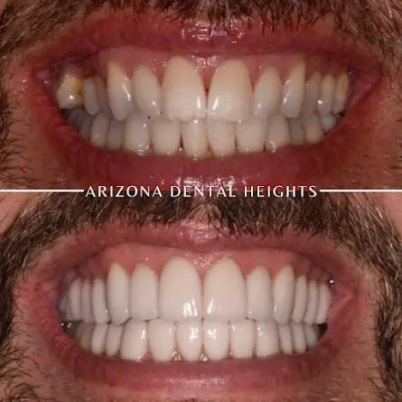 Dental Implants Close to Mesa