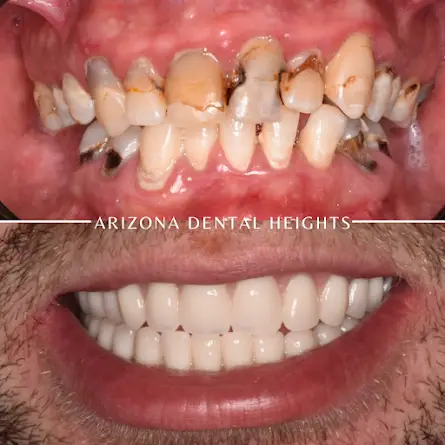 Best Dental Implants Mesa